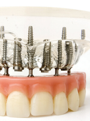 implant supported dentures